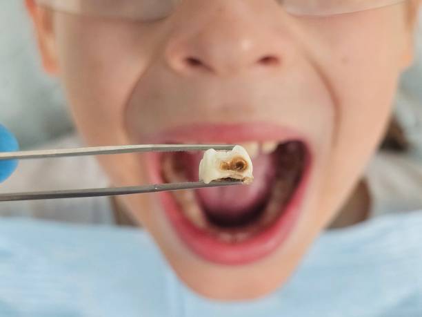 Best Emergency Wisdom Teeth Removal in Chilton, WI